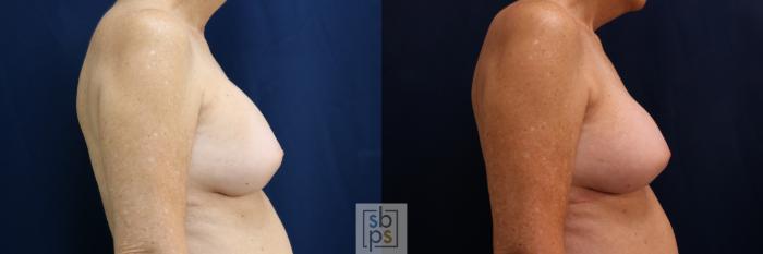 Before & After Breast Augmentation Revision Case 698 Right Side View in Los Angeles & Torrance, CA, CA