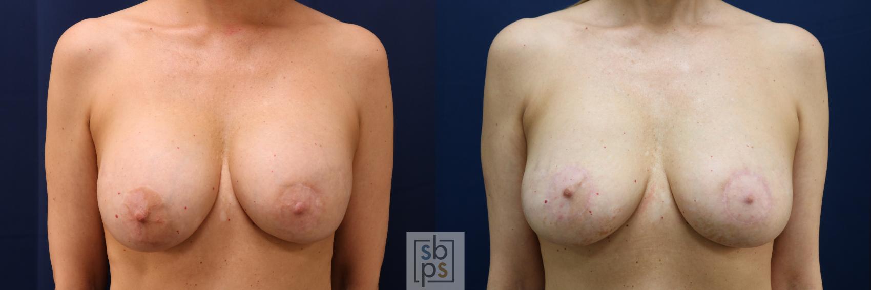 Before & After Breast Augmentation Revision Case 705 Front View in Los Angeles & Torrance, CA, CA