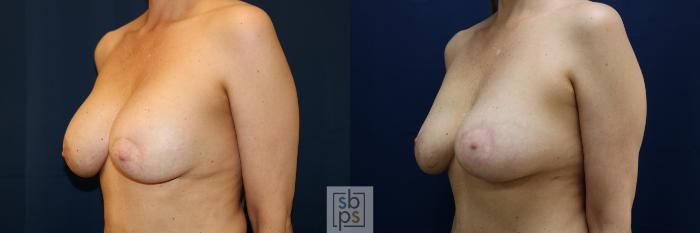 Before & After Breast Augmentation Revision Case 705 Left Oblique View in Los Angeles & Torrance, CA, CA