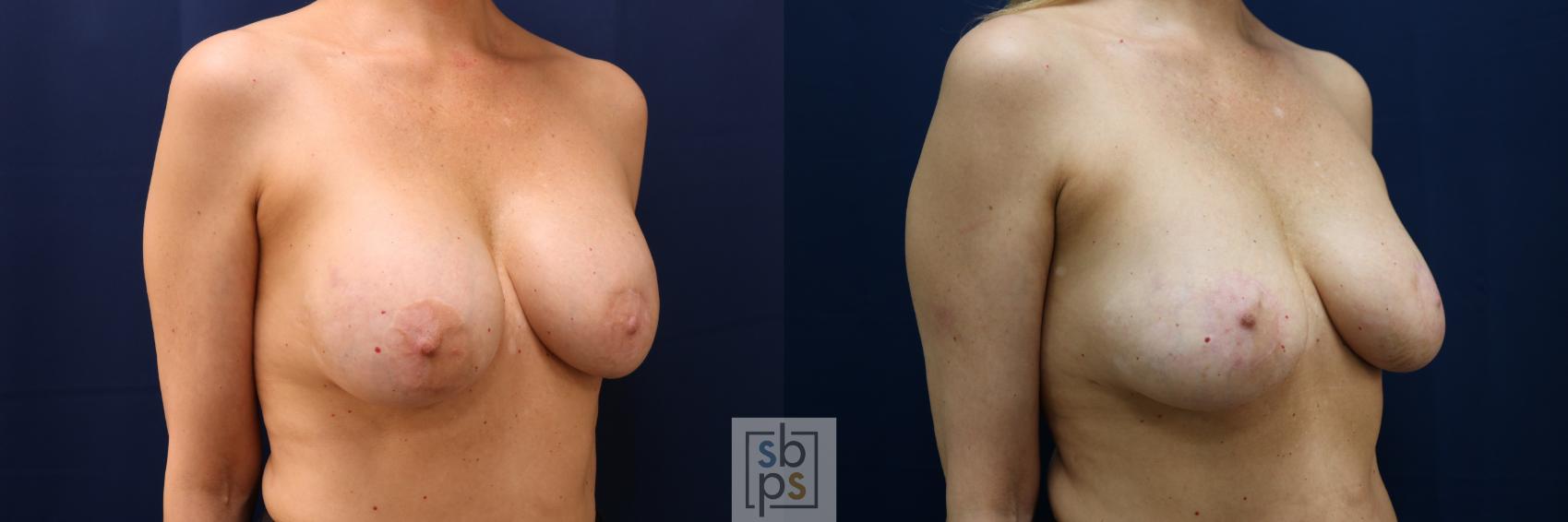 Before & After Breast Augmentation Revision Case 705 Right Oblique View in Torrance & Los Angeles, CA, CA