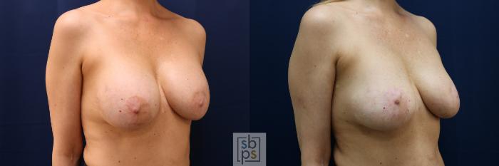 Before & After Breast Augmentation Revision Case 705 Right Oblique View in Los Angeles & Torrance, CA, CA