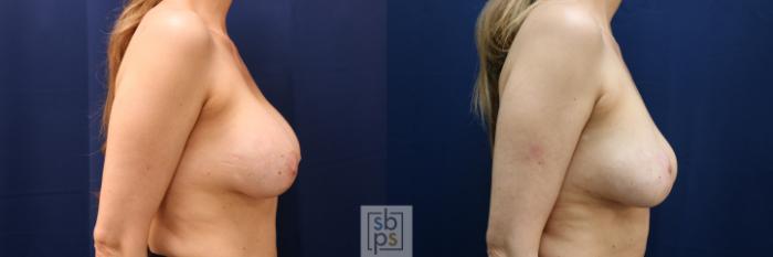 Before & After Breast Augmentation Revision Case 705 Right Side View in Los Angeles & Torrance, CA, CA