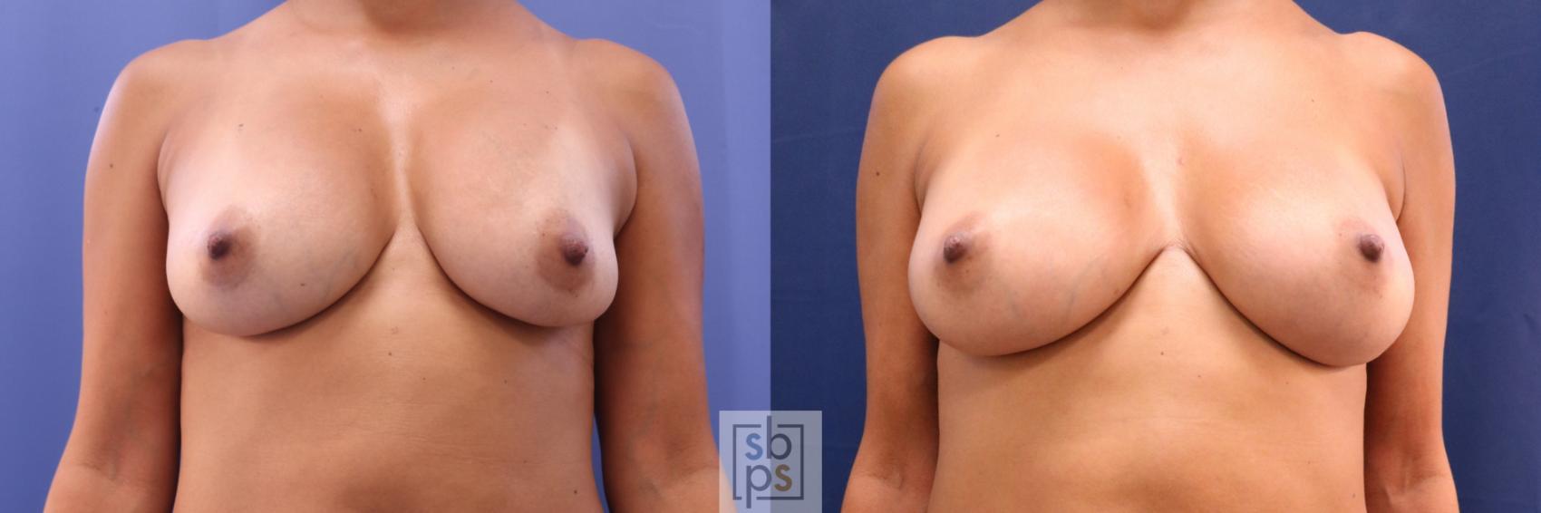 Before & After Breast Augmentation Revision Case 706 Front View in Los Angeles & Torrance, CA, CA