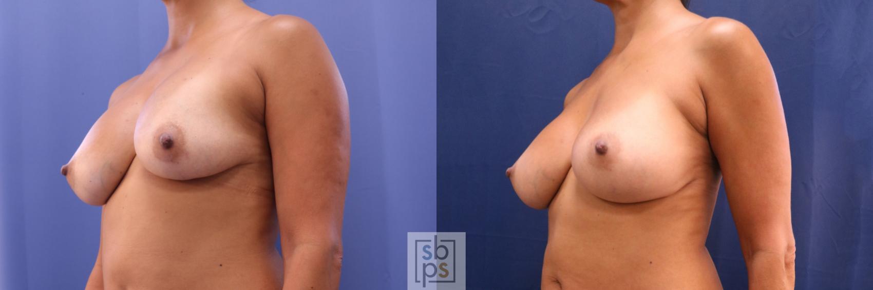 Before & After Breast Augmentation Revision Case 706 Left Oblique View in Torrance & Los Angeles, CA, CA