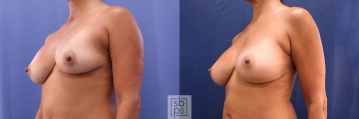 Before & After Breast Augmentation Revision Case 706 Left Oblique View in Los Angeles & Torrance, CA, CA