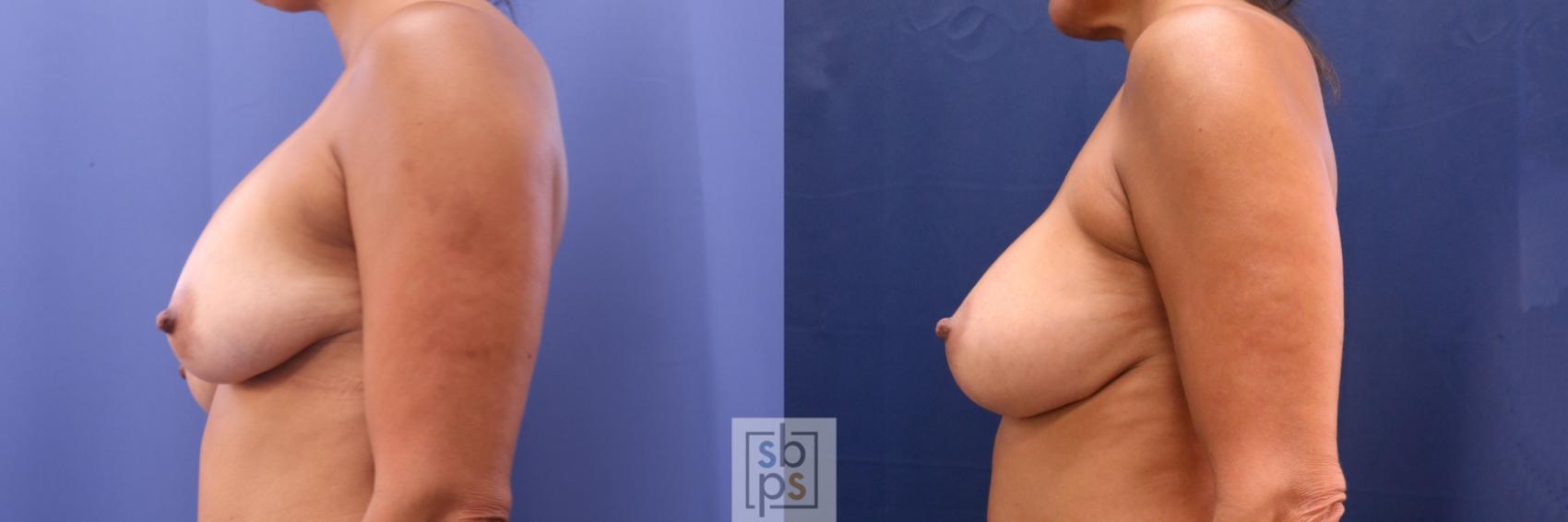 Before & After Breast Augmentation Revision Case 706 Left Side View in Torrance & Los Angeles, CA, CA