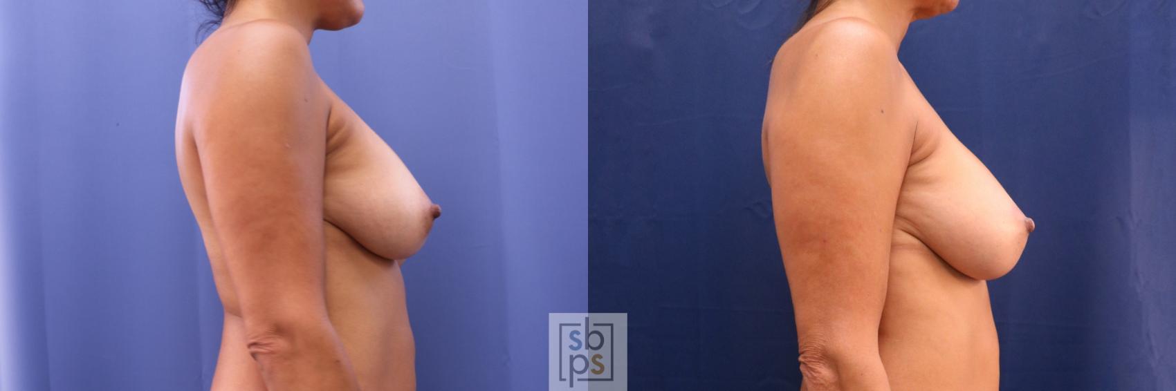 Before & After Breast Augmentation Revision Case 706 Right Side View in Torrance & Los Angeles, CA, CA