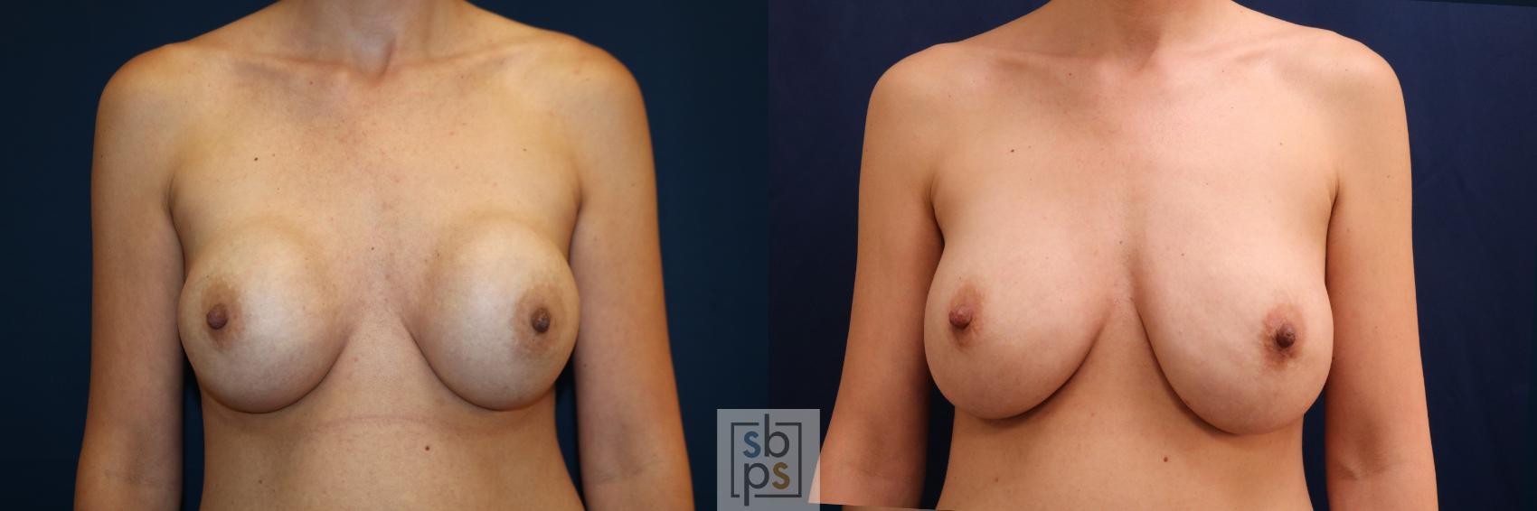 Before & After Breast Augmentation Revision Case 709 Front View in Los Angeles & Torrance, CA, CA