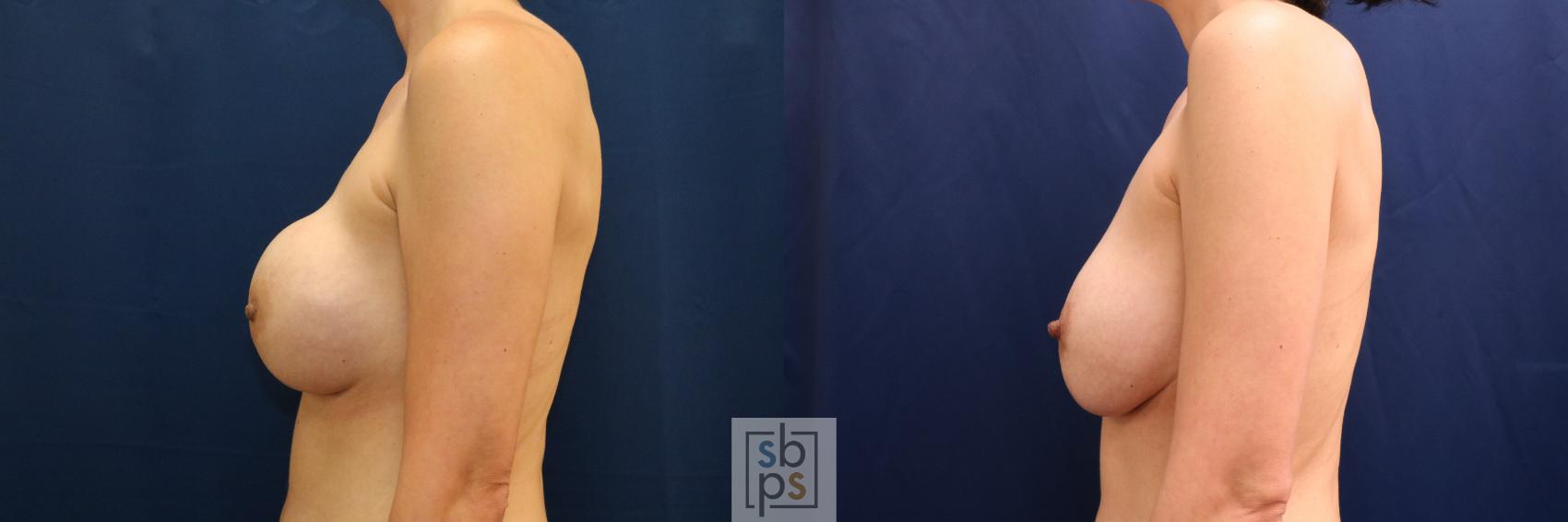 Before & After Breast Augmentation Revision Case 709 Left Side View in Torrance & Los Angeles, CA, CA