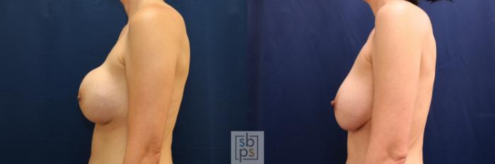 Before & After Breast Augmentation Revision Case 709 Left Side View in Los Angeles & Torrance, CA, CA