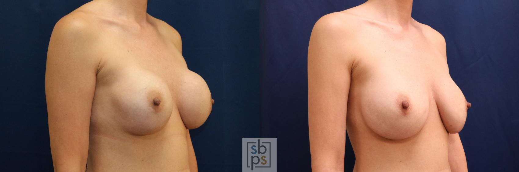 Before & After Breast Augmentation Revision Case 709 Right Oblique View in Torrance & Los Angeles, CA, CA