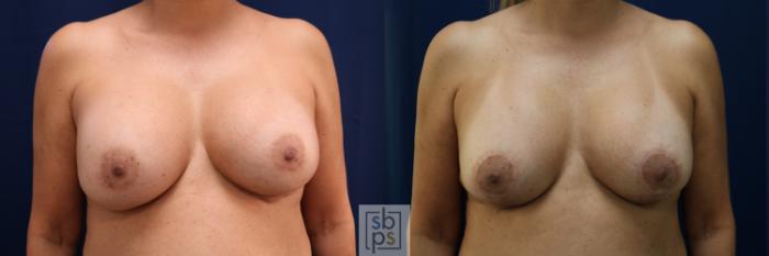 Before & After Breast Augmentation Revision Case 712 Front View in Los Angeles & Torrance, CA, CA