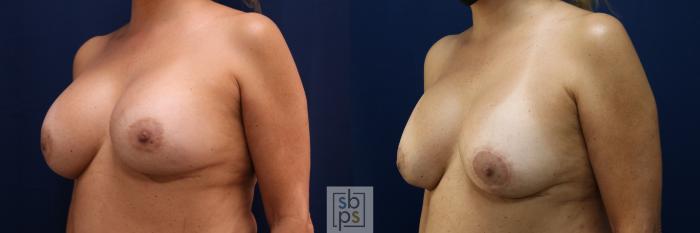 Before & After Breast Augmentation Revision Case 712 Left Oblique View in Los Angeles & Torrance, CA, CA