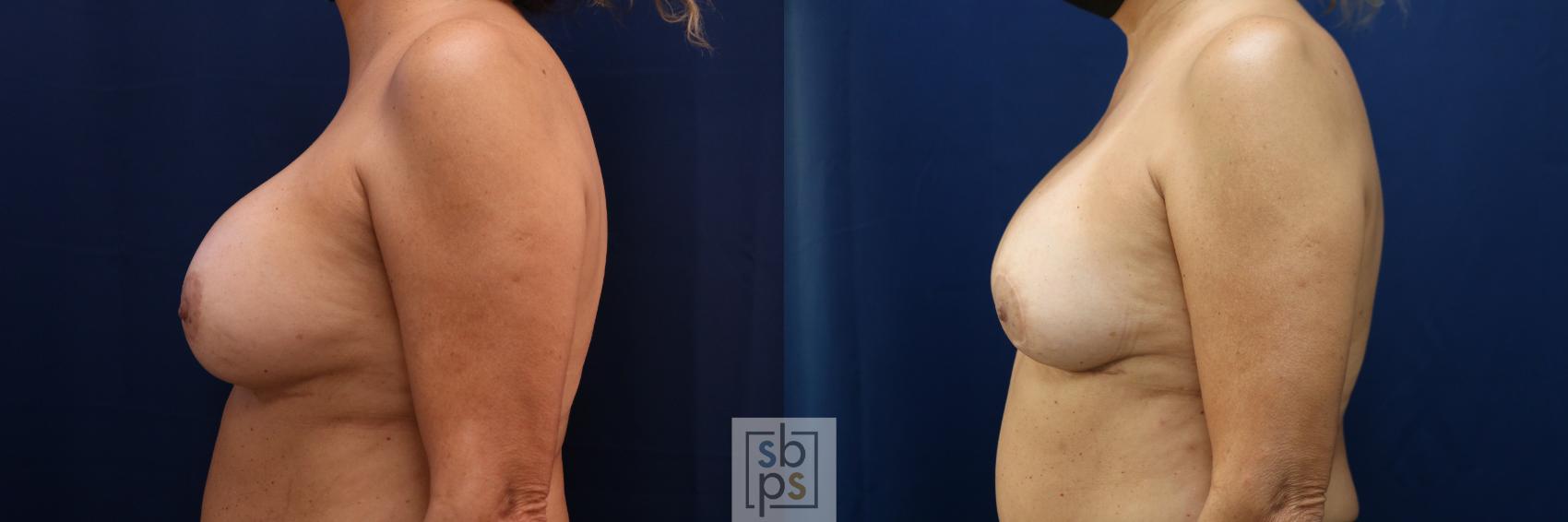 Before & After Breast Augmentation Revision Case 712 Left Side View in Torrance & Los Angeles, CA, CA