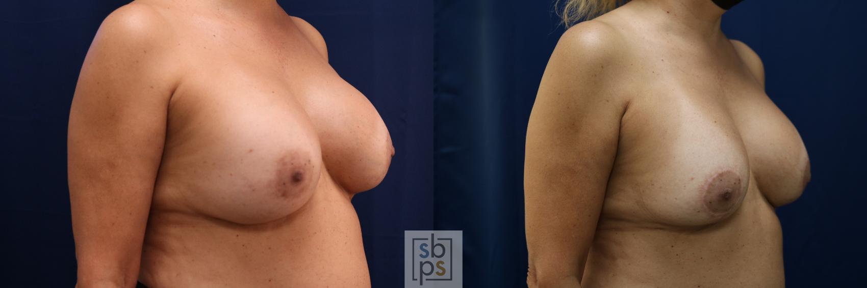 Before & After Breast Augmentation Revision Case 712 Right Oblique View in Torrance & Los Angeles, CA, CA