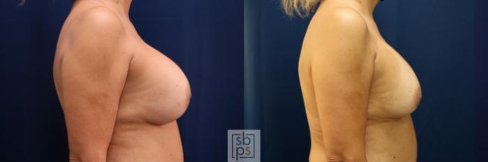 Before & After Breast Augmentation Revision Case 712 Right Side View in Los Angeles & Torrance, CA, CA