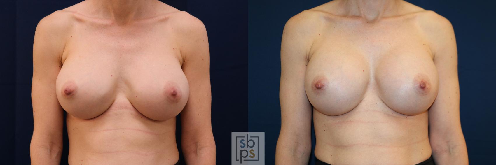 Before & After Breast Augmentation Revision Case 725 Front View in Los Angeles & Torrance, CA, CA