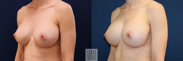 Before & After Breast Augmentation Revision Case 725 Left Oblique View in Los Angeles & Torrance, CA, CA