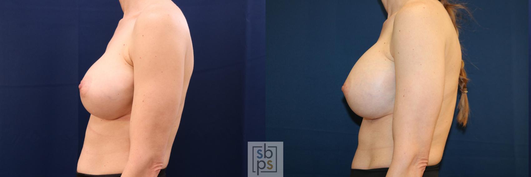 Before & After Breast Augmentation Revision Case 725 Left Side View in Torrance & Los Angeles, CA, CA