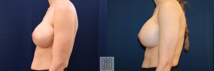 Before & After Breast Augmentation Revision Case 725 Left Side View in Los Angeles & Torrance, CA, CA