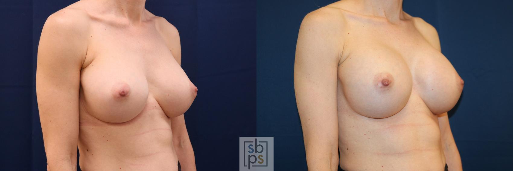 Before & After Breast Augmentation Revision Case 725 Right Oblique View in Torrance & Los Angeles, CA, CA