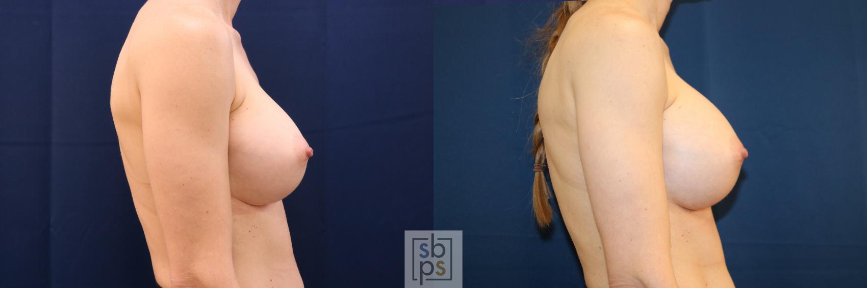 Before & After Breast Augmentation Revision Case 725 Right Side View in Torrance & Los Angeles, CA, CA