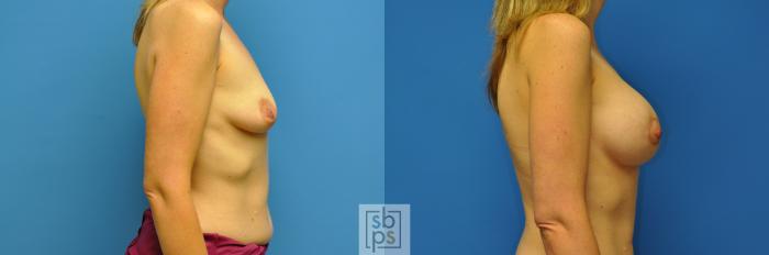 Before & After Breast Augmentation Case 107 View #2 View in Torrance, CA