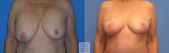 Before & After Breast Lift Case 109 View #1 View in Torrance, CA