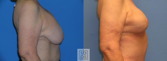 Before & After Breast Lift Case 109 View #2 View in Torrance, CA