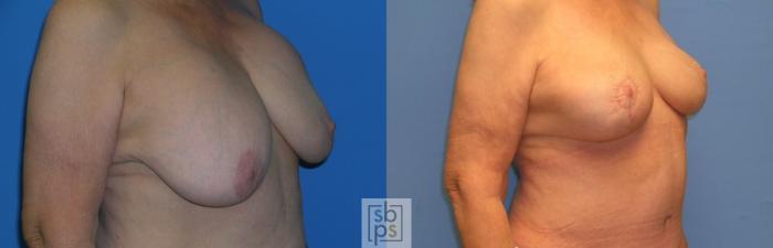 Before & After Breast Lift Case 109 View #3 View in Torrance, CA