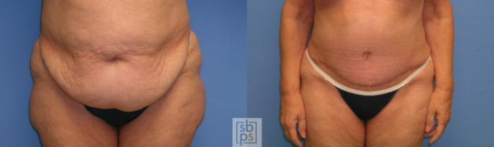 Before & After Tummy Tuck Case 109 View #4 View in Torrance, CA