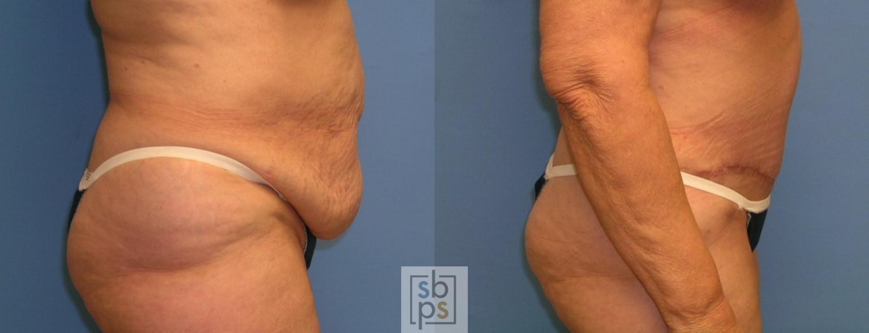 Before & After Tummy Tuck Case 109 View #5 View in Torrance & Los Angeles, CA, CA