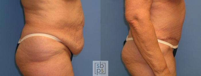 Before & After Tummy Tuck Case 109 View #5 View in Torrance, CA