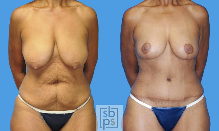 Before & After Breast Lift Case 234 View #1 View in Torrance, CA