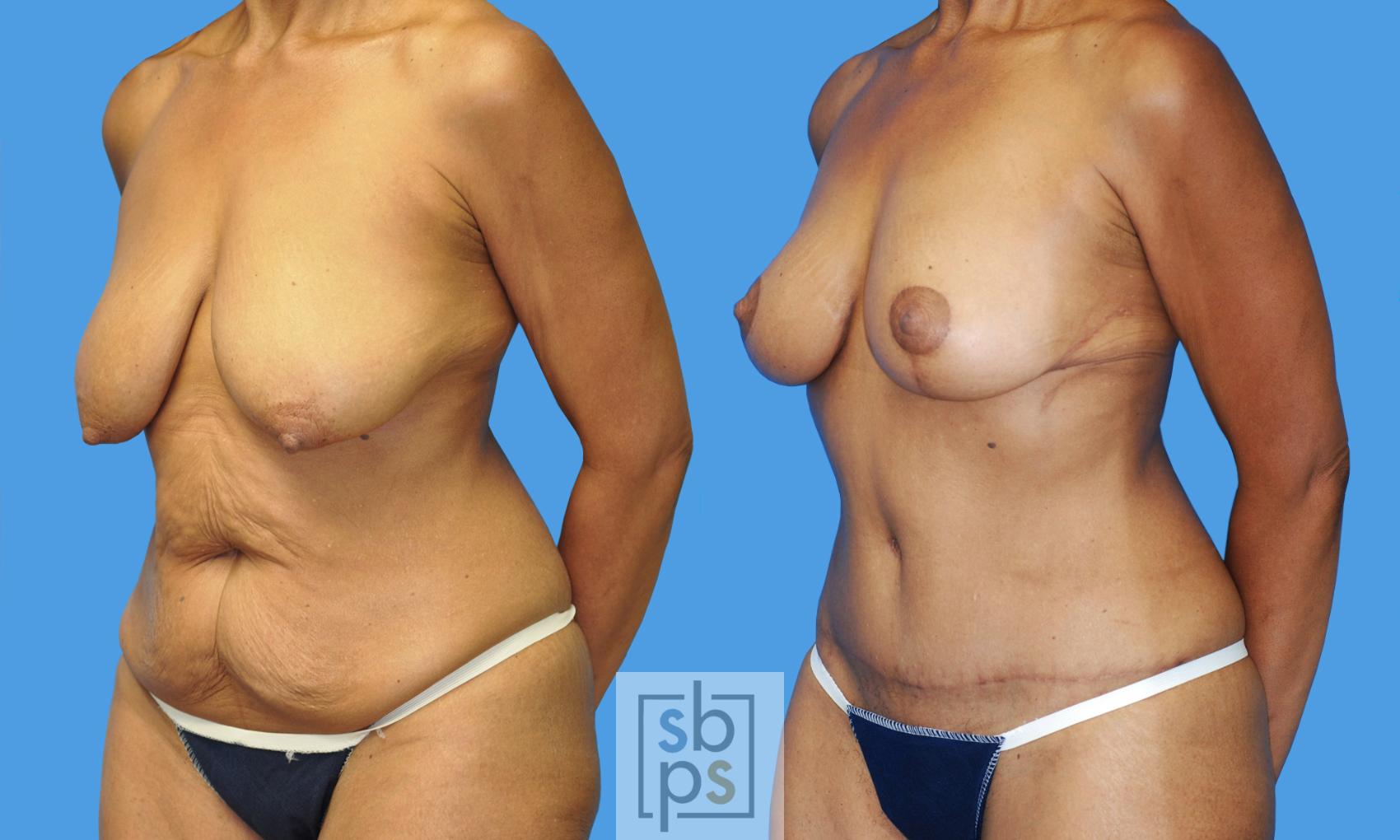 Before & After Breast Lift Case 234 View #2 View in Los Angeles & Torrance, CA, CA