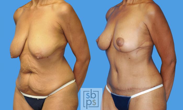 Before & After Breast Lift Case 234 View #2 View in Torrance, CA