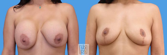 Before & After Breast Lift Case 243 View #1 View in Torrance, CA