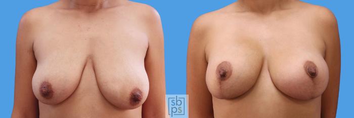 Before & After Breast Augmentation Case 244 View #1 View in Torrance, CA