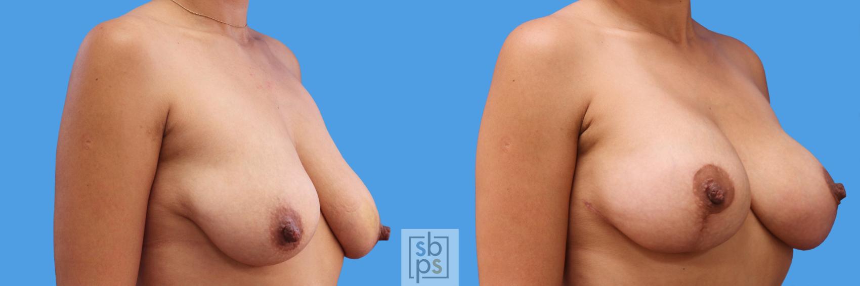 Before & After Breast Augmentation Case 244 View #2 View in Torrance, CA
