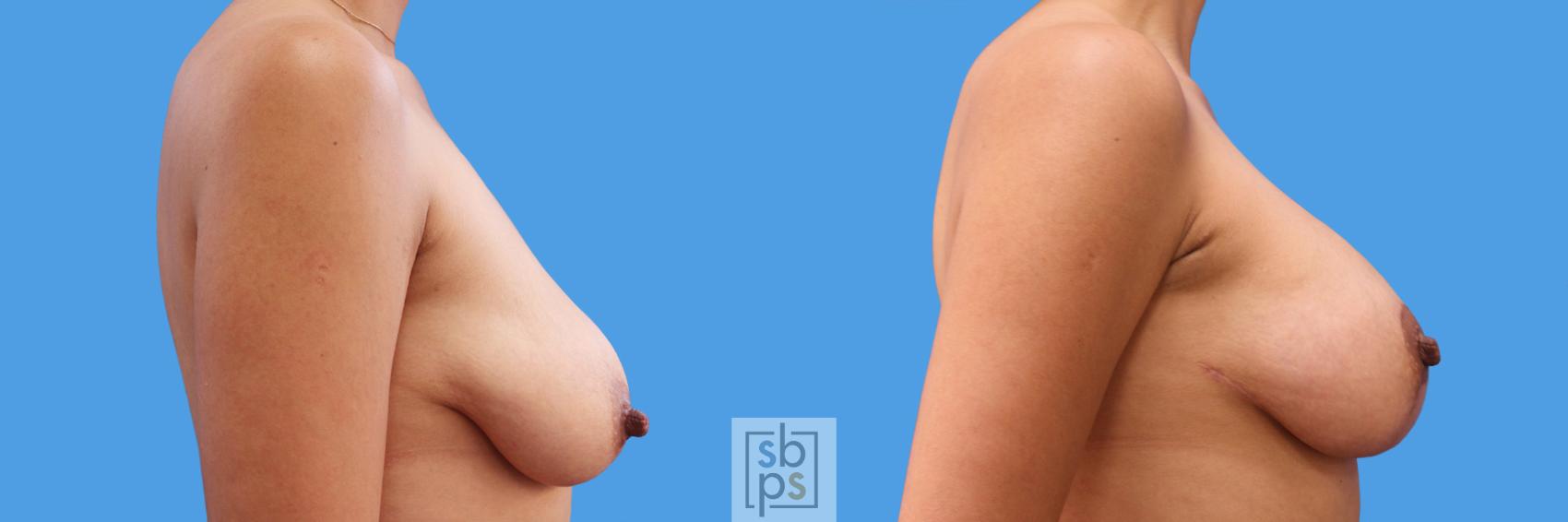 Before & After Breast Lift Case 244 View #3 View in Torrance, CA