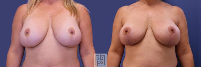 Before & After Breast Lift Case 256 View #1 View in Torrance, CA