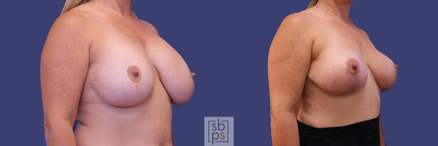 Before & After Breast Lift Case 256 View #2 View in Torrance & Los Angeles, CA, CA