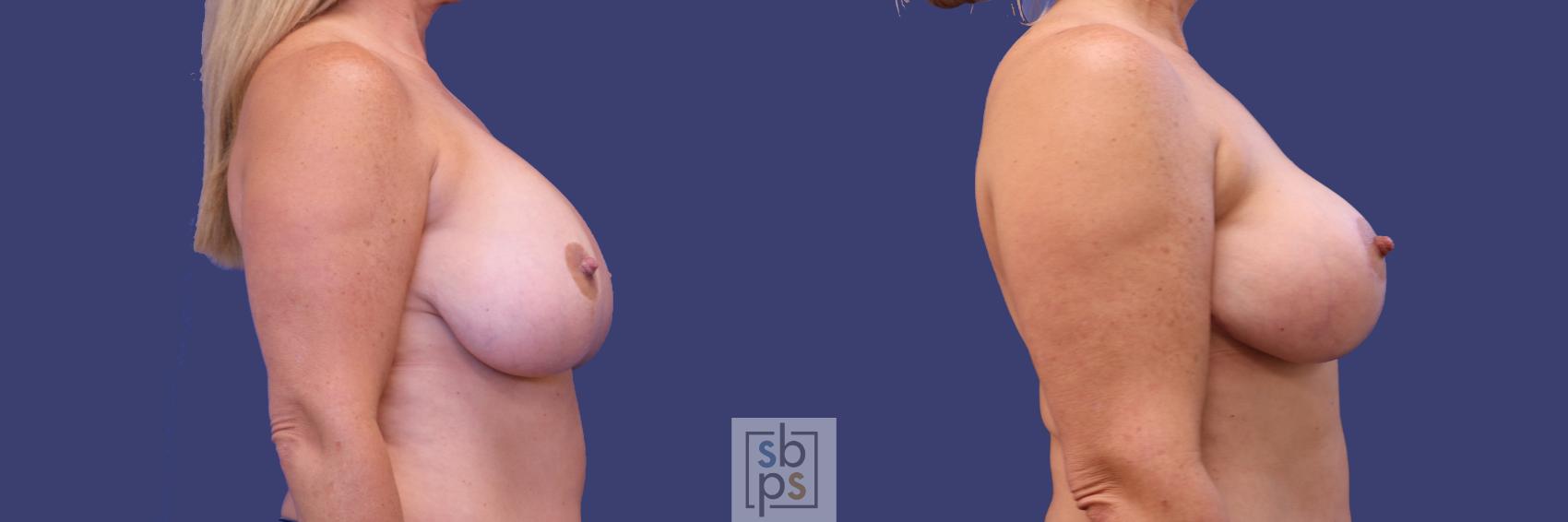 Before & After Breast Lift Case 256 View #3 View in Torrance & Los Angeles, CA, CA