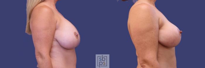 Before & After Breast Lift Case 256 View #3 View in Torrance, CA