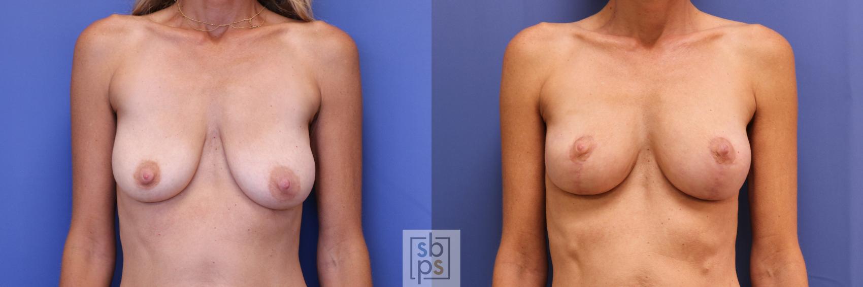 Before & After Breast Lift Case 271 View #1 View in Torrance, CA