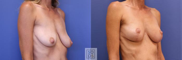 Before & After Breast Lift Case 271 View #5 View in Torrance, CA