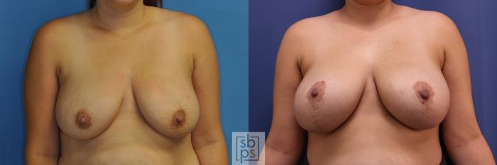 Before & After Breast Lift Case 353 View #1 View in Torrance, CA