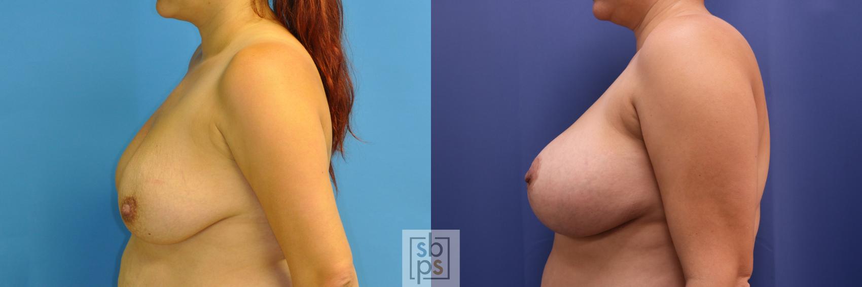 Before & After Breast Augmentation Case 353 View #2 View in Torrance & Los Angeles, CA, CA