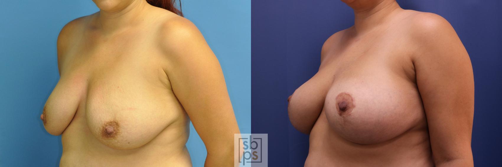 Before & After Breast Augmentation Case 353 View #3 View in Torrance & Los Angeles, CA, CA
