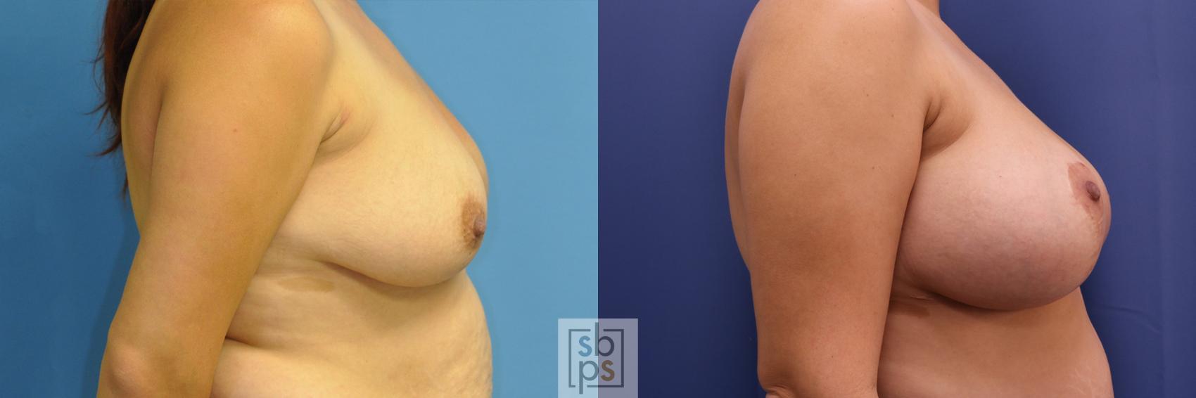 Before & After Breast Augmentation Case 353 View #4 View in Torrance & Los Angeles, CA, CA